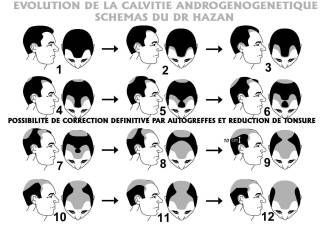 04 sens d'implantation des cheveux